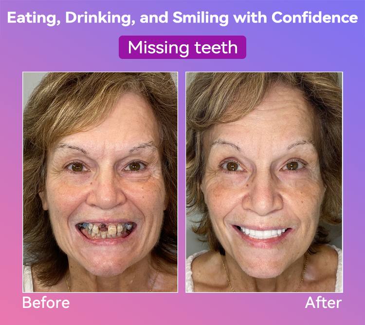 Vioralifes® Next-Generation Comfort Dentures (Luxurious dentures, lightweight and easy to wear — limited-time 70% OFF)