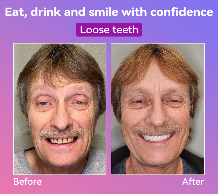 Vioralifes® Next-Generation Comfort Dentures (Luxurious dentures, lightweight and easy to wear — limited-time 70% OFF)