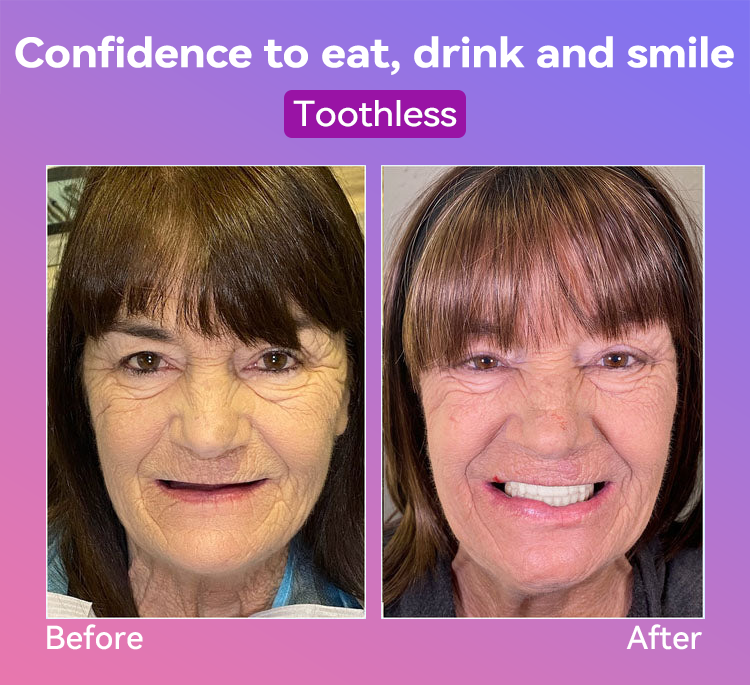 Vioralifes® Next-Generation Comfort Dentures (Luxurious dentures, lightweight and easy to wear — limited-time 70% OFF)