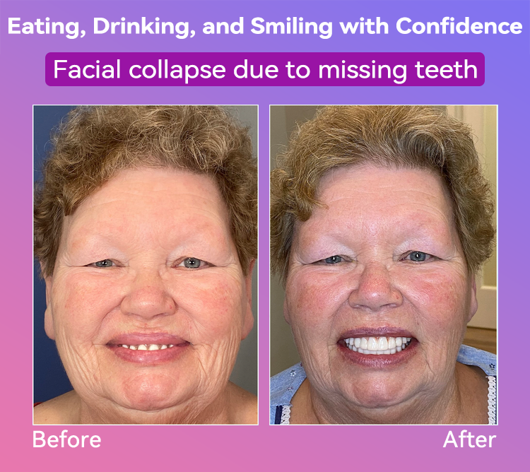 Vioralifes® Next-Generation Comfort Dentures (Luxurious dentures, lightweight and easy to wear — limited-time 70% OFF)