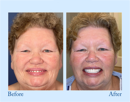 NESLEMY™ - Premium Denture